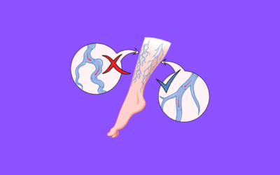 How Can I Improve Circulation In My legs?